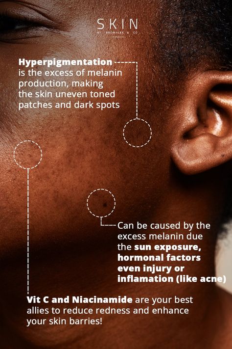 Did you know that hyperpigmentation is a common skin concern affecting many individuals? It's a condition where certain areas of the skin darken causing uneven patches on the skin. It occurs when the skin produces excess melanin, the pigment that gives skin its color, causing the skin to become darker in some areas compared to its surroundings🌞✨. Hyperpigmentation can occur due to different factors such as sun exposure, inflammation, hormonal factors, and medical conditions or medications. Skincare For Pigmented Skin, Skin Pigmentation Disorders, Acne Scar Hyperpigmentation, Skin Facts Skincare, Skincare Myths And Facts, Skin Darkening, African Skin Care, Skin Facts, Skin Science