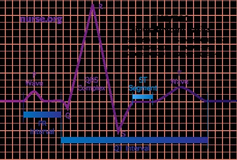 How To Read An Electrocardiogram (EKG/ECG) Ekg Interpretation Made Easy, Ekg Lead Placement Cheat Sheets, Ecg Placement, Ecg Reading, Ekg Tech, Lethal Rhythms Ekg, Ekg Electrode Placement, Ekg Rhythms, Ekg Interpretation