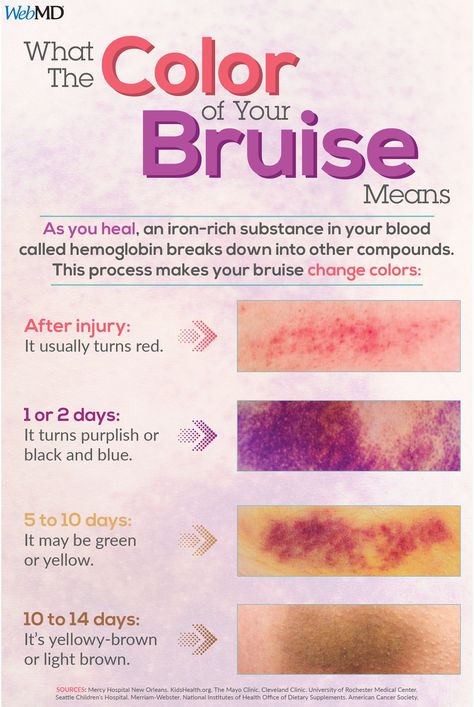 As a bruise heals, hemoglobin breaks down into other compounds. This process is what makes your bruise change colors. Materi Bahasa Jepang, Medical Student Study, Nursing School Survival, Nursing School Studying, Nursing School Tips, Medical School Essentials, Medical School Studying, Nursing School Notes, Phlebotomy