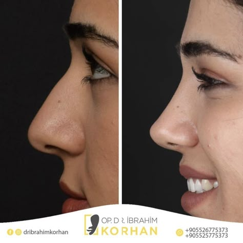 Nose Job Inspiration Rhinoplasty, Natural Nose Job Rhinoplasty, Nose Job Droopy Tip, Natural Looking Nose Job, Good Nose Jobs, Nose Plastic Surgery Before After, Nose Job Natural, Nose Before And After, Nose Job Inspiration Front View