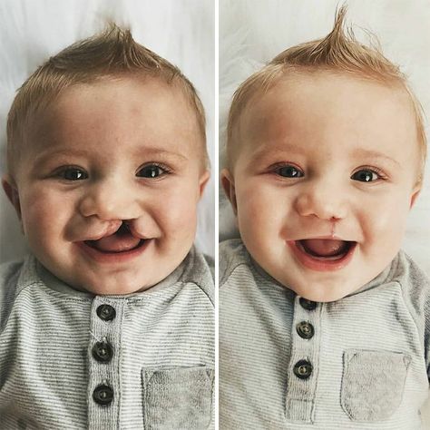 Cleft Lip And Cleft Palate. Two Weeks Post Surgery Lip Surgery, Cleft Lip And Palate, Halloween Pin Up, Cleft Palate, Cleft Lip, Carotid Artery, Burts Bees Baby, Meme Page, Baby D