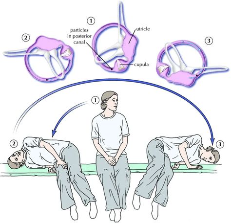 benign-paroxysmal-positional-vertigo-epley-maneuver Cervical Vertigo, Remedies For Vertigo, Home Remedies For Vertigo, Epley Maneuver, Ringing Ears Remedy, Vertigo Exercises, Vertigo Remedies, Vertigo Relief, Vestibular System