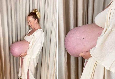 A rockstar mum has showed off her incredible pregnant belly shape while carrying her triplets, and we’re in awe! Michella Meier-Morsi,... Incredible Triplet Pregnancy Before And After Images was published on Mouths of Mums. Pregnant Belly Quadruplets, Huge Pregnant Belly Triplets, Huge Pregnant Belly Quadruplets, Pregnant Belly Huge Multiples, Pregnancy Before And After Photos, 4months Pregnant Belly, 2 Pregnant Best Friends, Triplet Pregnancy Belly, Three Months Pregnant Belly