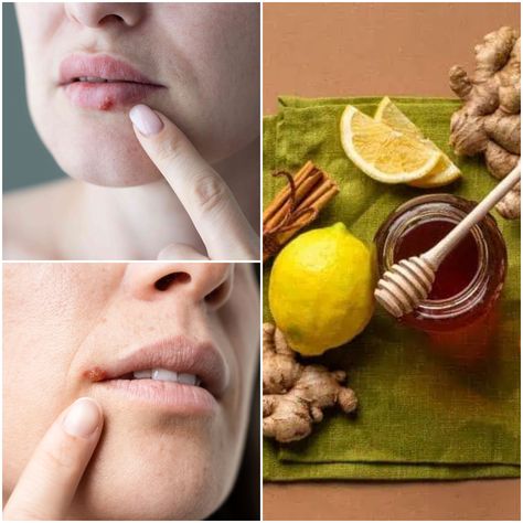 Home Remedies for Cold Sores Lip Sore Remedy, Sore Lips, Home Remedies For Cold, Healing Tips, Cold Sores, Natural Cold Remedies, Cold Home Remedies, Holistic Remedies, Cold Sore