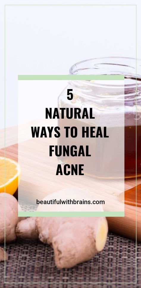 Fungal Acne, Forehead Acne, Acne Help, Natural Acne Remedies, Natural Acne, Acne Free, Acne Remedies, How To Get Rid Of Acne, Acne Skin