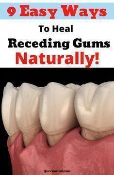 9 Easy Ways to heal receding gums naturally! Grow Back Receding Gums, Mouth Health, Gum Recession, Dental Health Care, Ways To Heal, Teeth Health, Makijaż Smokey Eye, Receding Gums, Gum Health