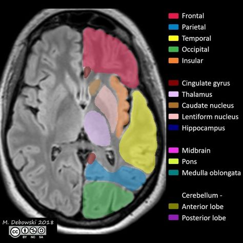 Neuroanatomy | Radiology Reference Article | Radiopaedia.org Pediatric Radiology, Brain Mri, Brain Lobes, Mri Technologist, Mri Brain, Radiology Student, Radiology Technician, Radiology Imaging, Interventional Radiology