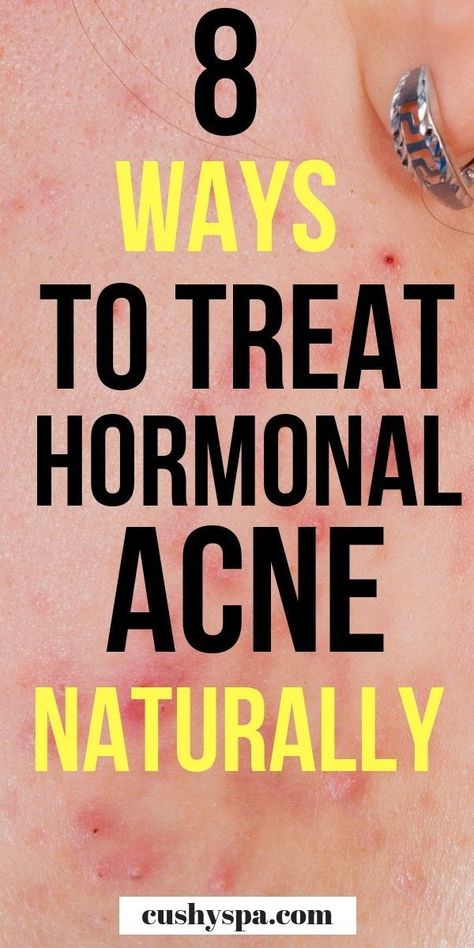 Treat Hormonal Acne, Acne Treatments, Natural Acne Remedies, Natural Acne, Severe Acne, Home Remedies For Acne, Hormonal Acne, Cystic Acne, Acne Remedies