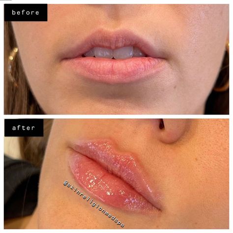 Skin Religion Medical Spa™️ on Instagram: “RUSSIAN LIP TECHNIQUE🤍 M-shaped lips are extremely difficult to correct & shape. What are M-shaped lips you ask? When the top lip is…” M Shape Lip Filler, M Shaped Lips, Lips Inspiration, Facial Contouring, Lip Filler, Lip Shapes, Lip Fillers, Shape Of You, Plastic Surgery