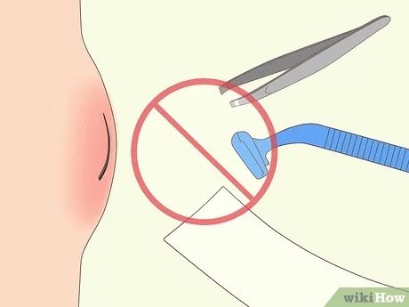 3 Simple Ways to Remove Deep Ingrown Hairs - wikiHow How To Remove Ingrown Hair, Itchy Legs, Infected Ingrown Hair, Treat Ingrown Hair, Ingrown Hair Remedies, Dental Tips, Ingrown Hair Removal, Skin Bumps, Ingrown Hairs