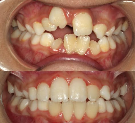 Bearing Teeth Reference, Types Of Teeth Shapes, Messed Up Teeth, Rotting Teeth, Teeth Reference, Loose Teeth, Teeth Art, Bad Teeth, Tooth Whitening