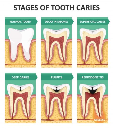 Stages of tooth caries | Premium Vector #Freepik #vector #medical #dental #dentist #tooth Stages Of Tooth Decay, Health Science Classroom, Dental Assistant Study Guide, Tooth Caries, Dentistry Art, Dental Poster, Dental Post, Dental Assistant Study, Dental Hygiene Student