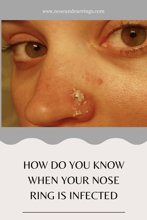 How Do You Know When Your Nose Ring Is Infected Keloids Nose Piercing, Infected Nose Ring, Infected Piercing, Infected Nose Piercing, Bull Nose Piercing, Nose Piercing Infection, Nose Piercing Bump, Piercing Bump, 8th Sign