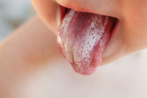 Systemic Diseases: Oral Signs to Watch for in Dental Patients - Today's RDH Asthma Spray, Candida Supplements, Candida Yeast Infection, Yeast Infection Symptoms, Kedokteran Gigi, Candida Overgrowth, Candida Yeast, Candida Albicans, Sikat Gigi