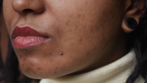 How To Deal With Hormonal Acne During Menopause Remedies For Hyperpigmentation, Acne Aesthetic, Nodule Acne, Jawline Acne, Fat Burning Cream, Pico Laser, Summer Skincare Routine, Post Inflammatory Hyperpigmentation, Treating Hyperpigmentation