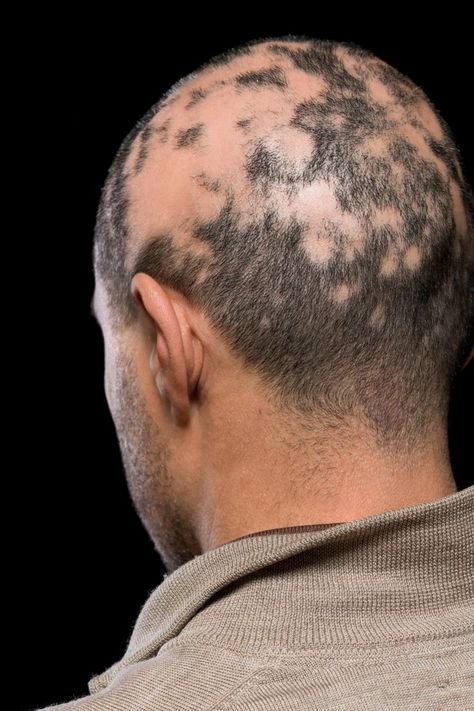 Alopecia universalis (AU) is a rare and severe type of alopecia areata. While alopecia areata is primarily known for causing round, sporadic patches of hair loss on the head, AU causes complete hair loss on both the scalp and the entire rest of the body Hairstyle Man, Alopecia Universalis, Alopecia Hairstyles, Clean Beauty Products, Everyday Health, Healthier Skin, For Healthy Skin, Lifestyle Habits, Hair Follicles