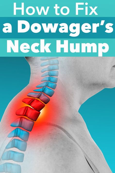 Hunchback Exercises Workout, Exercises For Sore Neck And Shoulders, Hump Neck Stretches, Fixing Bad Posture, Back Neck Hump Exercises, Natural Muscle Relaxer Neck, How To Reduce Back Neck Hump Women, Reduce Neck Fat Exercise, Pulled Neck Muscle Remedy