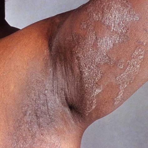 9 Common Skin Infections That Cause a Rash: Erythrasma Yeast Infection Pictures, Skin Rash Remedies, Home Remedies For Rashes, Clinic Poster, Fungal Rash, Fungal Infection Remedies, Rashes Remedies, Fungal Infection Skin, Home Remedies For Skin