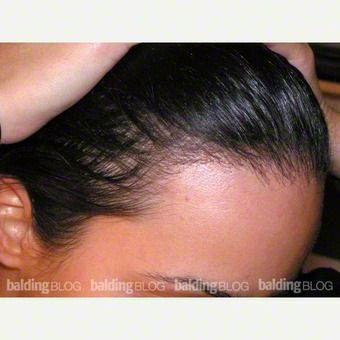 Forehead Reduction, Facial Fillers, After Pictures, Hair Transplant, Before And After Pictures, Old Woman, Behind Ear Tattoo, Year Old, Facial