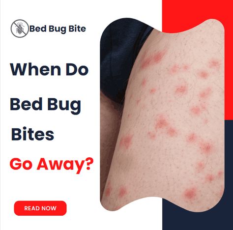 When Do Bed Bug Bites Go Away? - Bed Bug Bite Bed Bugs Bites, Bed Bug Bites Pictures, Bed Bugs Pictures, Signs Of Bed Bugs, Bug Bite Relief, Kill Bed Bugs, Rid Of Bed Bugs, Bed Bug Bites, Bug Bites