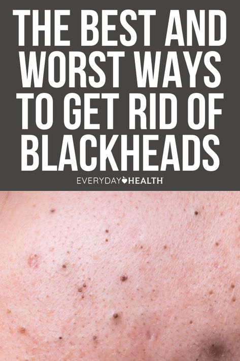 What Causes Blackheads? How to Prevent Blackheads on Your Skin The Best Ways to Get Rid of Blackheads The Worst Ways to Get Rid of Blackheads Acne comes in many shapes, sizes, and colors — and sometimes, the skin condition doesn’t look like an obvious blemish at all. Take blackheads, those pesky dark-colored gunk-filled spots. If you’ve ever tried squeezing one, you’ve probably found yourself facing down an angry bump instead and immediately regretted it. No Blackheads, How To Avoid Blackheads, Stubborn Blackheads Removal, How To Get Rid Of Stubborn Blackheads, Diy Blackheads Removal For Nose, Best Way To Remove Blackheads, How To Get Rid Of Blackheads On Cheeks, What To Use For Blackheads, How To Extract Blackheads