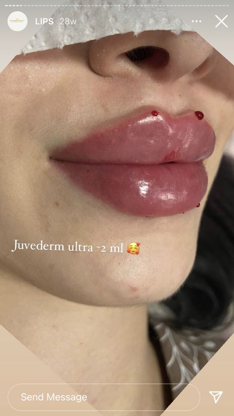 Big Lip Filler, Small Plump Lips, Korean Lip Filler, Plump Lips Aesthetic, Big Lips Aesthetic, Russian Lips Filler, Small Lips Aesthetic, Desired Lips, Lip Filler Aesthetic