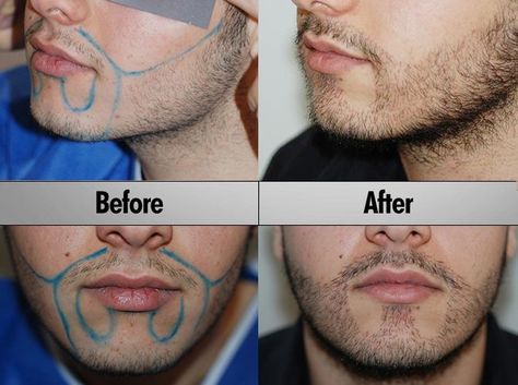 #beard #hairtransplantgujarat beard hair transplant in gujarat Beard Transplant, Facial Hair Growth, Hair Transplant Cost, Hair Transplant Results, Beard Shapes, Fue Hair Transplant, Best Hair Transplant, Hair Clinic, Full Beard