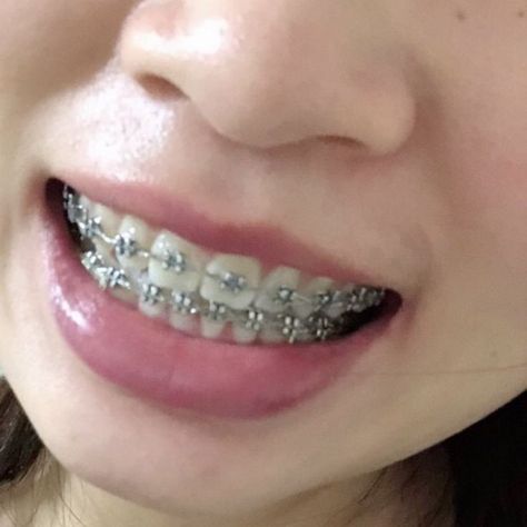 Gray Braces Teeth, Perfect Teeth Braces, Braces And Glasses, Braces Food, Silver Braces, Braces Smile, Cute Braces Colors, Teeth Aesthetic, Adult Braces