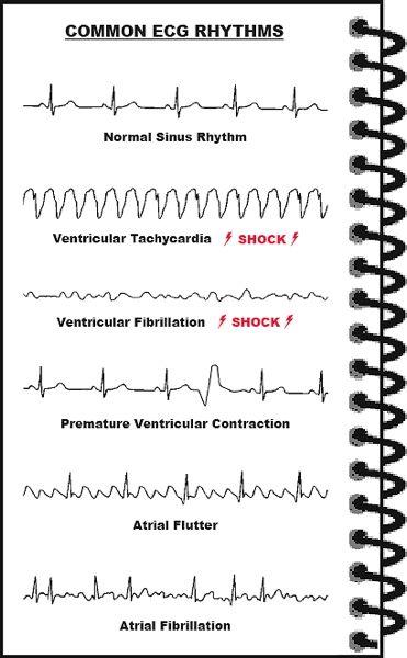 Abnormal ECG rhythms Ekg Rhythms, Nerdy Nurse, Nursing Mnemonics, Cardiac Nursing, Medical Student Study, Pa School, Nursing School Survival, Nursing Life, Being A Nurse