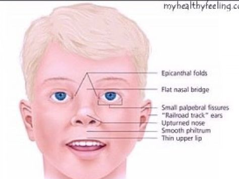 Prader-Willi Syndrome A genetic disorder that causes obesity, intellectual disability, and shortness in height. Prader-Willi syndrome is caused by the loss of function of genes in a particular region of chromosome 15. Foetal Alcohol Syndrome, Digeorge Syndrome, Prader Willi Syndrome, Fetal Alcohol Spectrum Disorder, Parenting Support, Fetal Alcohol, Foster Care Adoption, Build Community, Adoptive Parents