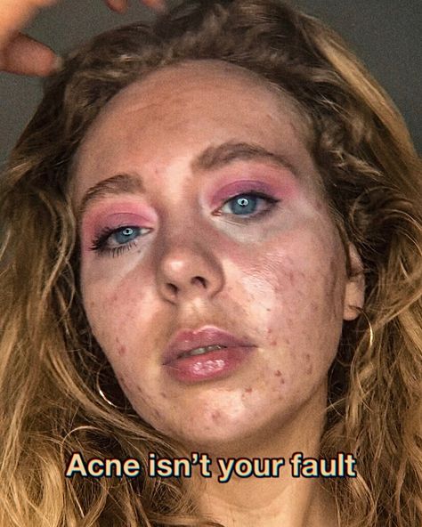 Acne positivity skin positvity @spottylittlething Acne Representation, Acne Positivity Quotes, Acne Positive, Acne Is Beautiful, Strawberry Freckles, Acne Is Normal, Acne Photos, Its Your Fault, Acne Awareness