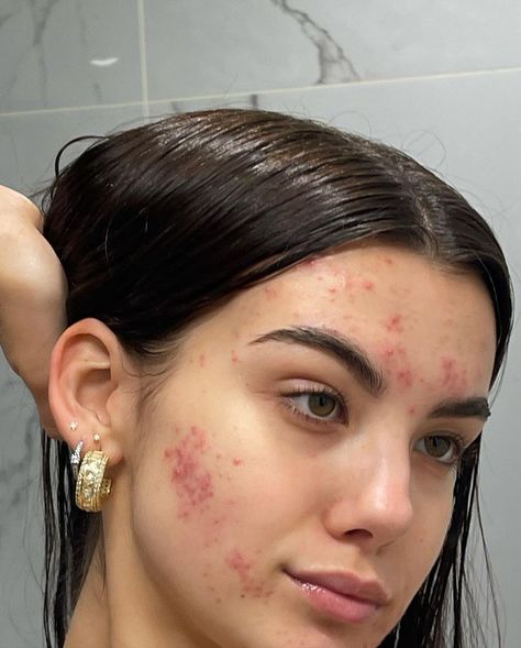 Strawberry Freckles, Acne Is Beautiful, Acne Positive, Acne Is Normal, Acne Aesthetic, Girl With Acne, Acne Positivity, Skin Positivity, Best Dark Spot Corrector