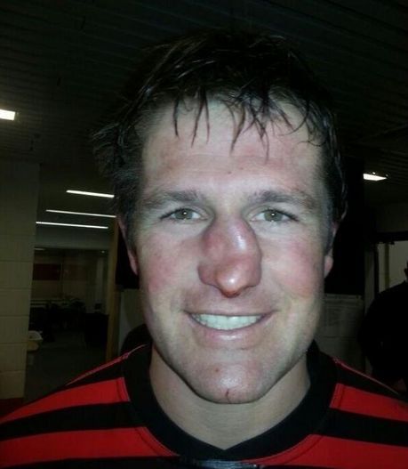 Broken Nose Hester Shaw, Nose Picture, Rugby Injuries, Flight Medic, South African Rugby, Broken Nose, Christmas Dog Outfits, English Club, Media Makeup