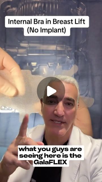 Dr. Kaveh Alizadeh on Instagram: "Considering a breast lift requires careful consideration and weighing of options, so it's crucial that you're well-informed about all the available choices.

The NaturaBra® is a technique pioneered by Dr. Alizadeh—a breast lift method that uses a patient's own tissue to create an internal support system, ensuring a natural and long-lasting breast lift.

In contrast, other doctors use the galaFLEX technique which requires foreign materials to be inserted internally, which can potentially lead to reactions such as inflammation or discomfort. While both techniques serve their purpose, Dr. Alizadeh recommends NaturaBra® for its elimination of such risks, offering a safer, natural approach to achieving youthful, lifted breasts.✨

With results lasting up to 20 y Breast Lift Before And After, Breast Lift