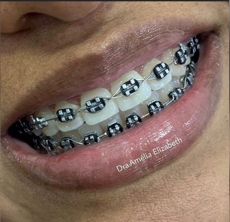 Braces Black Color, Braces With Black Bands, Black Braces Power Chain, Braces Colors Black, Black Braces Aesthetic, Braces Aesthetic Girl, Black Braces Teeth, Black Braces Bands, Brackets Aesthetic