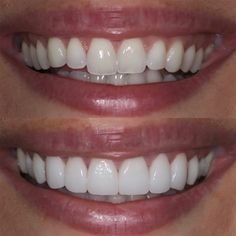 Teeth Makeover, Composite Bonding, Pretty Teeth, New Teeth, Veneers Teeth, Beautiful Teeth, Loose Tooth, Porcelain Veneers, Perfect Teeth