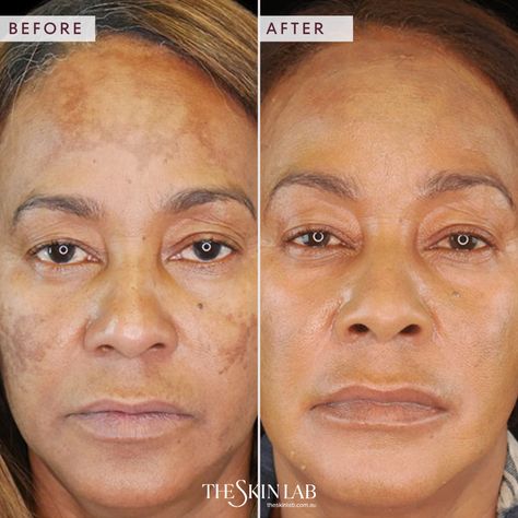 Laser Genesis Before And After, Skin Structure, Healing, The Incredibles, Skin, Books