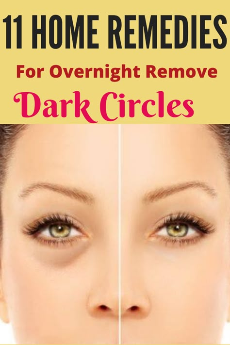 Eye Dark Circles, Overnight Beauty Tips, Dark Circle Remedies, Getting Rid Of Dandruff, Mind Diet, Dark Eye Circles, Natural Beauty Remedies, Overnight Beauty, Remove Dark Circles