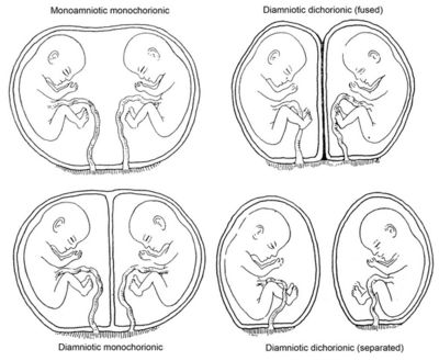 Fraternal Twins vs Identical Twins - Difference and Comparison Chinese Pregnancy Calendar, Twins In The Womb, Twins Ultrasound, Types Of Twins, Pregnancy Chalkboard, Medical Ultrasound, Pregnancy Calendar, Pregnancy Calculator, Ob Nursing