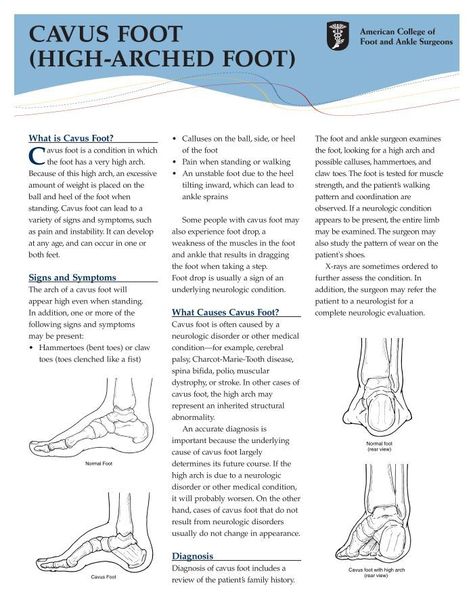 CAVUS FOOT (HIGH-ARCHED FOOT) High Arch Foot, Body Reflexology, Foot Exercises, High Arches, Tongue Tie, Things To Learn, Reflexology, Chronic Pain, Gym Life