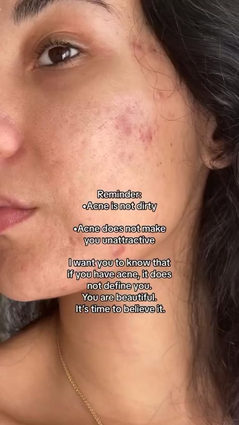 Acne positivity Girls With Acne, Strawberry Freckles, Acne Is Beautiful, Acne Positive, Serums For Acne, Acne Is Normal, How To Feel Pretty, Acne Journey, Acne Positivity