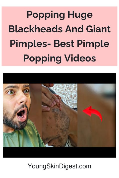 Popping Huge Blackheads And Giant Pimples- Best Pimple Popping Videos Dr Pimple Poppìng Videos, Squeezing Blackheads Watches, Huge Pimple Pop Video, Satisfying Pimple Videos Popping, Pimple Poppìng Videos New, Pimple Poppìng Videos Satisfying, Blackheads Popping Videos Nose, Boil Popping Videos, Ear Blackheads