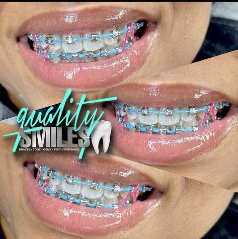 Star Shaped Braces, Cotton Candy Braces, Braces Color Patterns, Red And Blue Braces, Braces Colors With Rubber Bands, 2 Braces Colors Ideas, Powerchain Braces Colors Ideas, Power Chain Braces Black Women, Braces With Power Chains