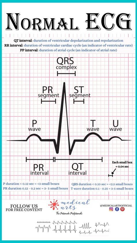 Normal ECG cheatsheet explains the mechanism of PQRST , helps calculate the durations of PQRST in seconds and in small boxes counts (blocks). Simplified version for easy reading. Nursing Survival Kit, Ecg Reading, Normal Ecg, Cardiac Cycle, Human Heart Anatomy, Pr Interval, Basic Anatomy, Basic Anatomy And Physiology, Medical Videos