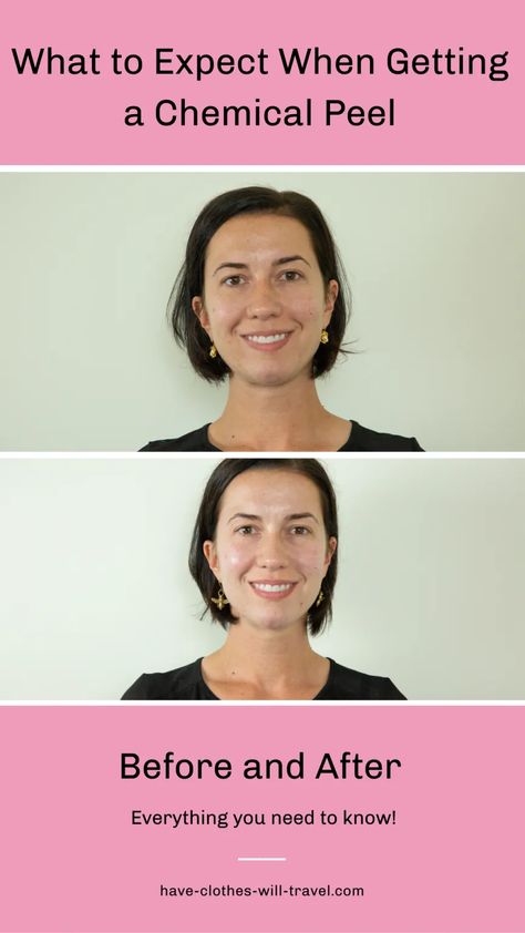 Are you interested in getting a chemical peel but aren't sure what to expect? This post is sharing everything you need to know before and after a chemical peel...plus photos of my face throughout the peeling process. (All of these photos are taken without makeup - to give you the best idea of what my skin looks like.)  | before and after chemical peel photos | chemical peel benefits | chemical peel aftercare #beauty #skincare Chemical Peel Benefits, Best Chemical Peel, Chemical Face Peel, Pca Skin Care, Makeup Skincare Routine, Facial Benefits, Complete Makeup, Type Of Skin, Face Peel