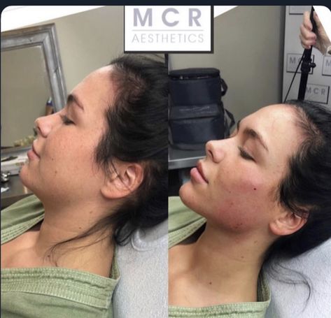 Face Injections, Face Plastic Surgery, Nose Fillers, Rhinoplasty Nose Jobs, Lips Inspiration, Face Fillers, Botox Lips, Cheek Fillers, Facial Surgery