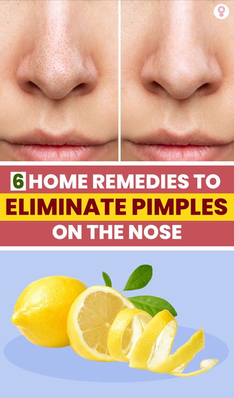 If you are wondering how to get rid of pimples on the nose, we have a solution for you. Whether you have oily skin or not, the T-zone, which includes the nose, has the most sebaceous glands and produces too much sebum. #skin #skincare #glowskin #bodyscrubs #skincaretips #healthyskin Oily Nose, Nose Pimples, Home Remedies For Pimples, Homemade Body Care, Get Rid Of Pimples, Rid Of Pimples, Clean Blackheads, Beauty Hacks Skincare, How To Get Rid Of Pimples