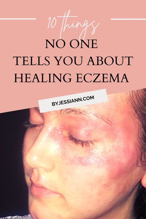 10 Steps to Getting Eczema Under Control - Skincare for Dry Skin Skincare For Dry Skin, Atopic Skin, Severe Dry Skin, Tips For Oily Skin, Cream For Oily Skin, Dry Skin On Face, Dry Skin Patches, Moisturizer For Oily Skin, Skin Routine