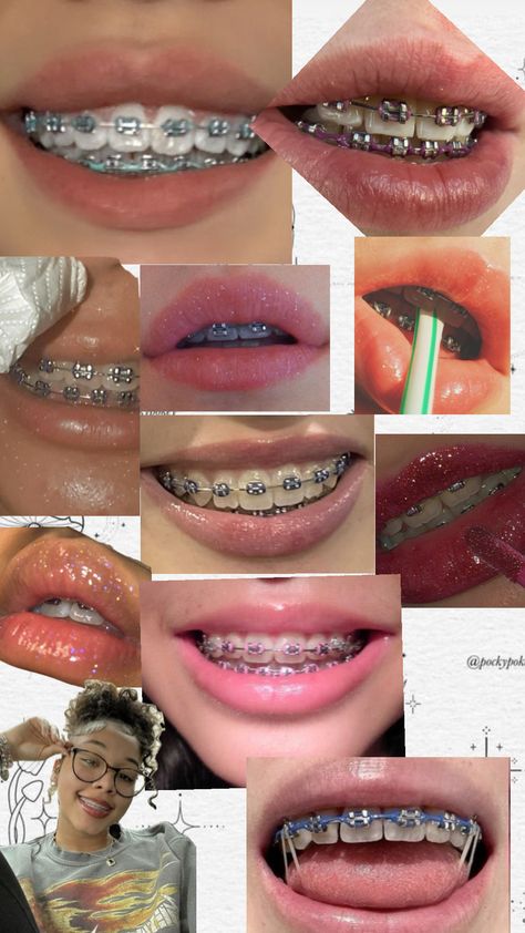 #myfirstshuffle Tips For Braces, Brace Colors, Fashion Braces, Braces Colours, Types Of Teeth, Drip Shoes, K Letter Images, Braces Ideas, Nails Gems