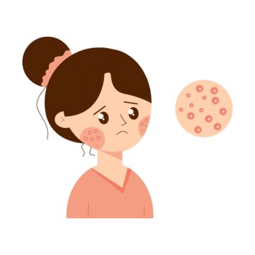 Acne Animation, Skin Care Cartoon, Acne Images, Acne Drawing, Acne Illustration, Skincare Graphics, Skincare Icon, Jawline Acne, Back Acne Remedies